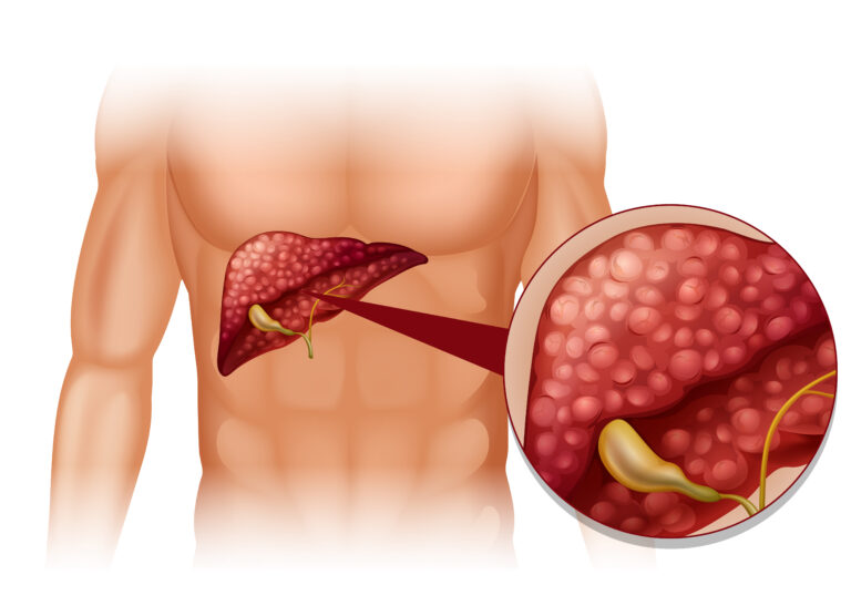 The Ultimate Guide on How to Get Rid of Fatty Liver : Unlocking 100 times Healthier You