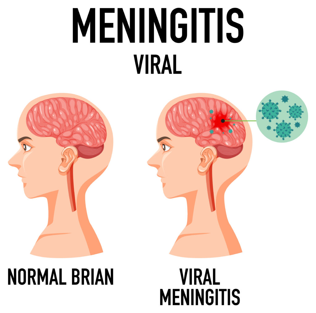 How to Cure Meningitis
