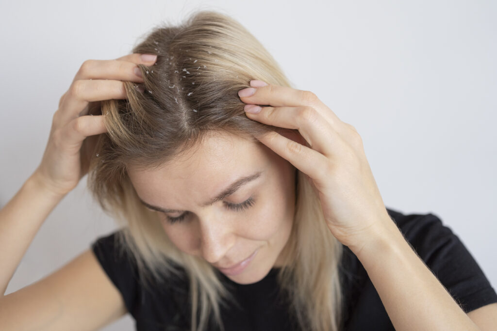 Home Remedies for Itchy Scalp