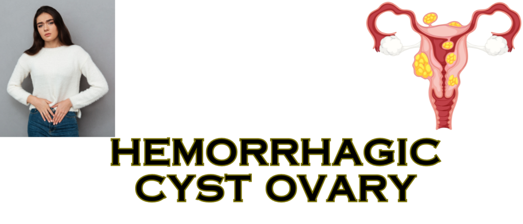 Hemorrhagic Cyst Ovary