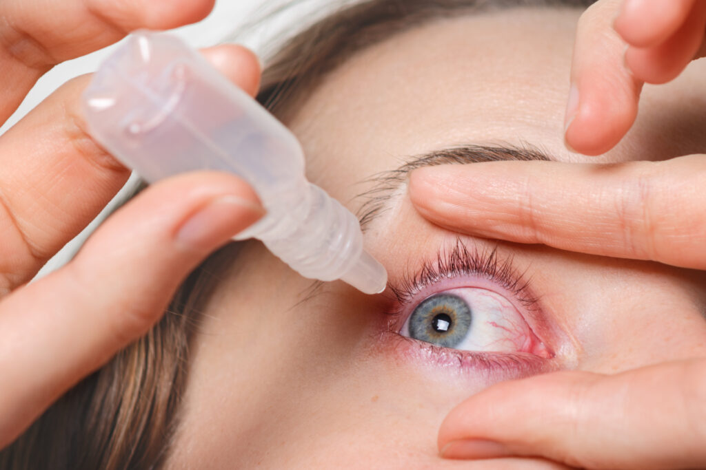 How to Cure Conjunctivitis at Home