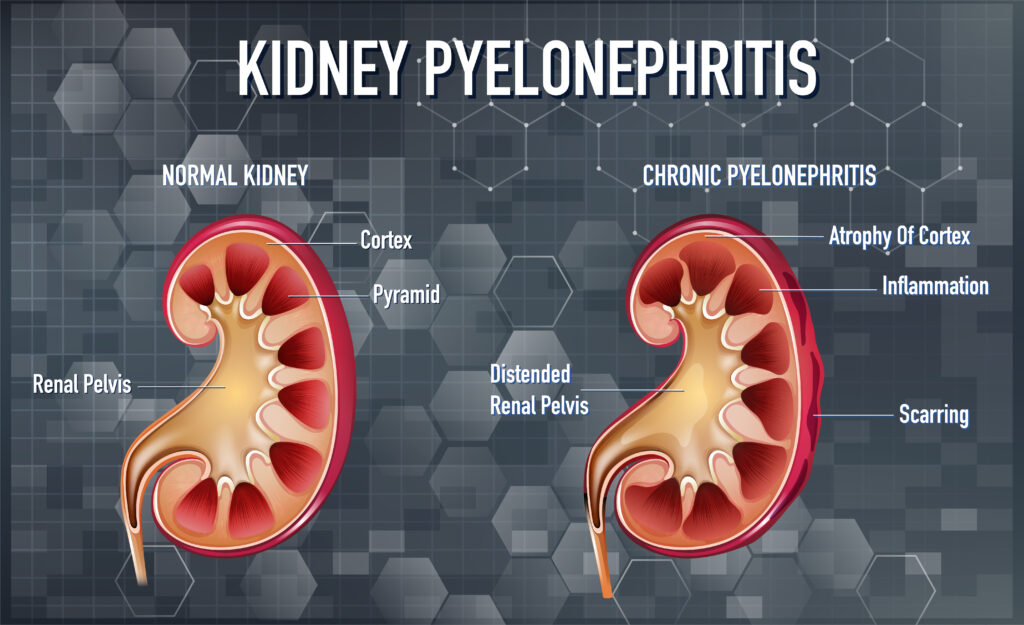 How to Cure Pyelonephritis