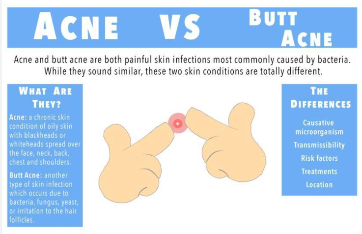 How to Remove Butt Acne at Home
