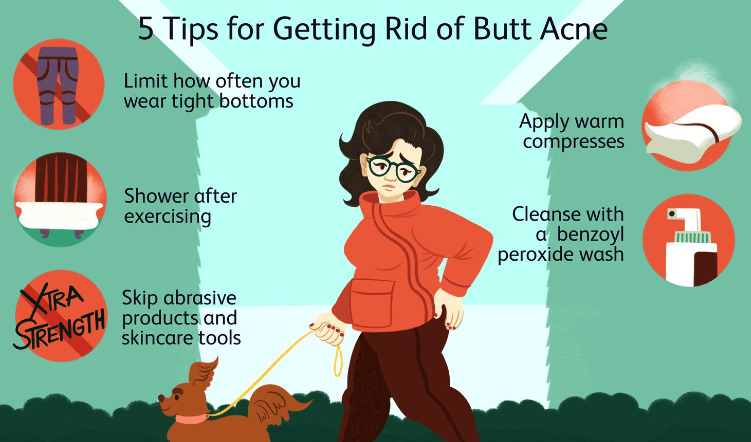 How to Remove Butt Acne at Home